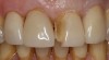 A patient presented with a fractured veneer on tooth No. 9.