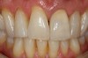 The crown was stained and glazed to match tooth No. 8, then adhesively cemented following patient approval.