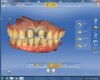 After scanning the “Buccal Bite,” the software compiled the three scans to mimic the patient’s maximum intercuspation.