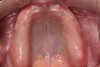 Figure 1 The edentulous maxilla.