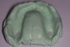 Figure 4 After the heavy-body material set, inspection revealed that the tray showed through the impression in several areas. These were relieved with an acrylic bur.