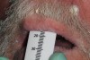 Figure 12 A photograph was taken of the lip ruler in position.