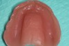 Figure 18 Intaglio surface of the final denture.