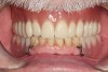 Figure 19 The final denture fit perfectly when it was tried in.