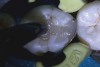 (5.) Placement of composite into tooth No. 19.