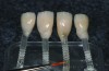 Fig 4. The IPS e.max Press cores (0.3 mm) can be seen on the stumps.