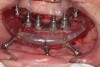 Fig 18. Mandibular implant placement completed.