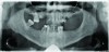 Fig 4. Preoperative panoramic radiograph revealing the failing dentition.