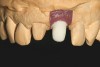 Fig 15. The completed “H” abutment was placed on the implant analog on the master model.