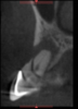 Figure 2. A fracture is evident on this upper incisor.