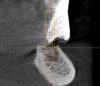 Fig. 5 through Fig. 9 Implants had to be placed in limited bone on severely resorbed ridge while avoiding the mandibular nerve. The most predictable way to get the maximum number and size implants was with CBCT data, a virtual plan, and a surgical guide.