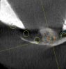 Fig. 5 through Fig. 9 Implants had to be placed in limited bone on severely resorbed ridge while avoiding the mandibular nerve. The most predictable way to get the maximum number and size implants was with CBCT data, a virtual plan, and a surgical guide.