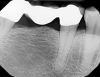 Fig. 10 through Fig. 15 By knowing about the buccal concavity in advance, the implant could be moved mesially and placed through a tissue punch using a guide. This saved the patient the discomfort and expense of a flap and possible graft.