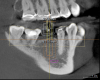 Fig. 10 through Fig. 15 By knowing about the buccal concavity in advance, the implant could be moved mesially and placed through a tissue punch using a guide. This saved the patient the discomfort and expense of a flap and possible graft.