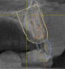 Fig. 16 and Fig. 17 An implant being placed virtually relative to available bone, soft tissue, and the final restoration. A screw-retained restoration was the goal and a buccal bone graft was planned prior to surgery. Because the surgery was planned and the area requiring grafting was known, a conservative flap sparing the papilla could be done.