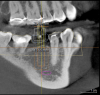 Fig. 22 through Fig. 26 This implant shifted slightly to the mesial to avoid the buccal concavity and bone graft. The implant was placed with a guide and a tissue punch was done, negating a flap.