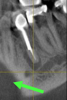 Fig. 27 through Fig. 30 The radiograph shows a periapical radiolucency. Three slices from the CBCT show a clear root fracture and buccal fistula showing an unrestorable tooth. With the CBCT information, the doctor can explain alternatives to the patient and not be surprised at the time of surgery.