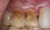 Figure 3  In a patient who smoked a pipe, the nicotinic acid causing tooth erosion was accentuated by the use of a highly abrasive smoker’s toothpaste. Some of the teeth have been restored with bonded composite resin.