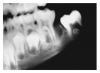 Fig 5. Mixed Dentition. Image courtesy of Lippincott, Williamson, Wilkins. 2003.