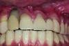 Fig 5. Maxillary right lateral incisor implant restoration with severe bone and soft tissue loss is classified a major complication which may not be completely reversible.