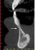 Fig 9. Hourglass configuration of the mandible: cross-sectional view. This is an unusual shape (arrow) of the mandible. A site with this anomaly requires bone grafting before implant placement, or the site can be skipped in favor of another, more favorable location.