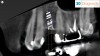 Fig 10. By merging CBCT files with IOS files and using implant planning software, dental professionals can plan all components of the implant/restoration procedure in advance for a restoratively driven approach: CBCT, IOS, and CAD merged and overlayed as one (Fig 9); implant placement and implant guide CAD (Fig 10).