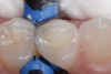 11. A bulk-fill composite (Beautifil-Bulk Restorative, Shofu) is used to complete the occlusal aspect of the restoration.