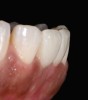 Fig. 12  The postoperative situation: right lateral view. Clinical work and photographs by Dr. Markus Blatz, dental technology by Michael Bergler, MDT.
