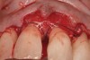 Fig. 15 A resorbable membrane sutured around the teeth bordering the intrabony defect.