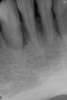 Fig. 17  A significant intrabony defect around tooth No. 27.
