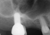 Fig. 21  Pretreatment radiograph suggesting more than 2 mm of subantral, alveolar bone.