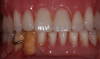 Fig 2. Case 1 after fabrication of the restoration.