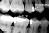 Fig 2. Radiograph shows single 4-mm incremental bulk-fill placement compared to using a layered method.