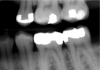Fig 7. Class II case with caries on distal surface shown on radiograph.