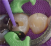 Fig 12. Adhesive application in preparation for bulk filling with dual-cure composite.