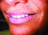 Fig 6. Subtle differences can be seen in the positions of denture teeth on a trial base.