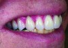 Fig 10. The teeth within the lip frame on the trial base while the patient smiles broadly.