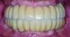 Fig 15. Intraoral frontal view of completed maxillary and mandibular zirconia restorations.