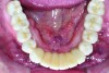 Fig 19. Intraoral occlusal views of maxillary (Fig 18) and mandibular (Fig 19) zirconia restorations at 1.5 years.