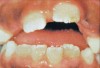 Fig. 2 Malocclusion (<a href-"www.nohic.nidcr.nih.gov" target="_blank">www.nohic.nidcr.nih.gov</a>).