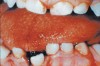 Fig. 4 Oral trauma—occurs more frequently in people with mental retardation, abnormal reflexes, or muscle incoordination (<a href-"www.nohic.nidcr.nih.gov" target="_blank">www.nohic.nidcr.nih.gov</a>).