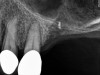 Radiograph of gutta percha placed at the base of the initial osteotomy with a round bur to verify location.
