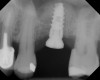 Radiograph of implant No. 14 with sinus augmentation, day of placement. The floor
of the sinus has been raised about 7 mm to 8 mm.