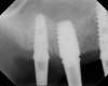 A 6.5-month postoperative radiograph. Teeth Nos. 2 and 4 have been extracted and an immediate implant had been placed in the No. 4 position.