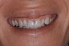 Fig 1. Example of a patient with a gummy smile.