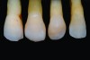 Fig 19. Lateral incisors: cross-polarization.