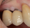 Improvement in tissue health around an implant after use of an oral irrigator.
