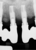 Radiographs showing bone loss around an implant.
