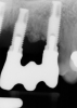 Radiographs showing bone loss around an implant.