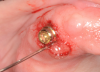 Cannula used to administer ozone subgingival therapy for treatment of peri-implant mucositis.
